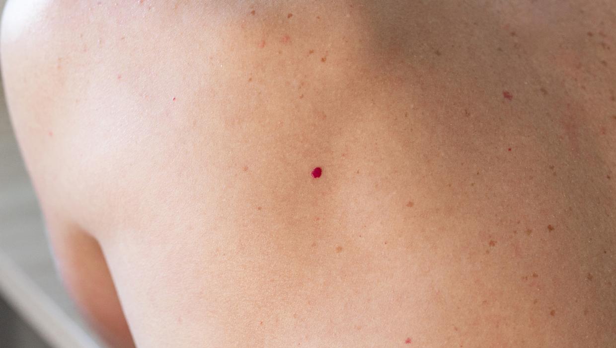 Prevención del fotoenvejecimiento y cáncer de piel: cómo proteger tu piel del sol